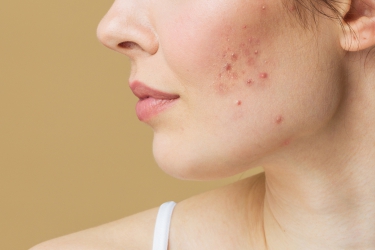 Acne Treatment in Purnia, Best Skin Specialist for Acne Treatment, Dr Poonam Raut, Skyn Laser Clinic, Cost of Acne Treatment