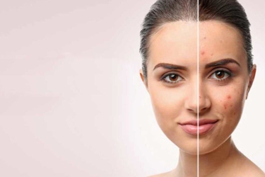 Laser Scar Removal in Purnia, Skyn & Laser Clinic, Dr Poonam Raut, Best Skin and Laser Specialist, Cost of Laser Scar Removal